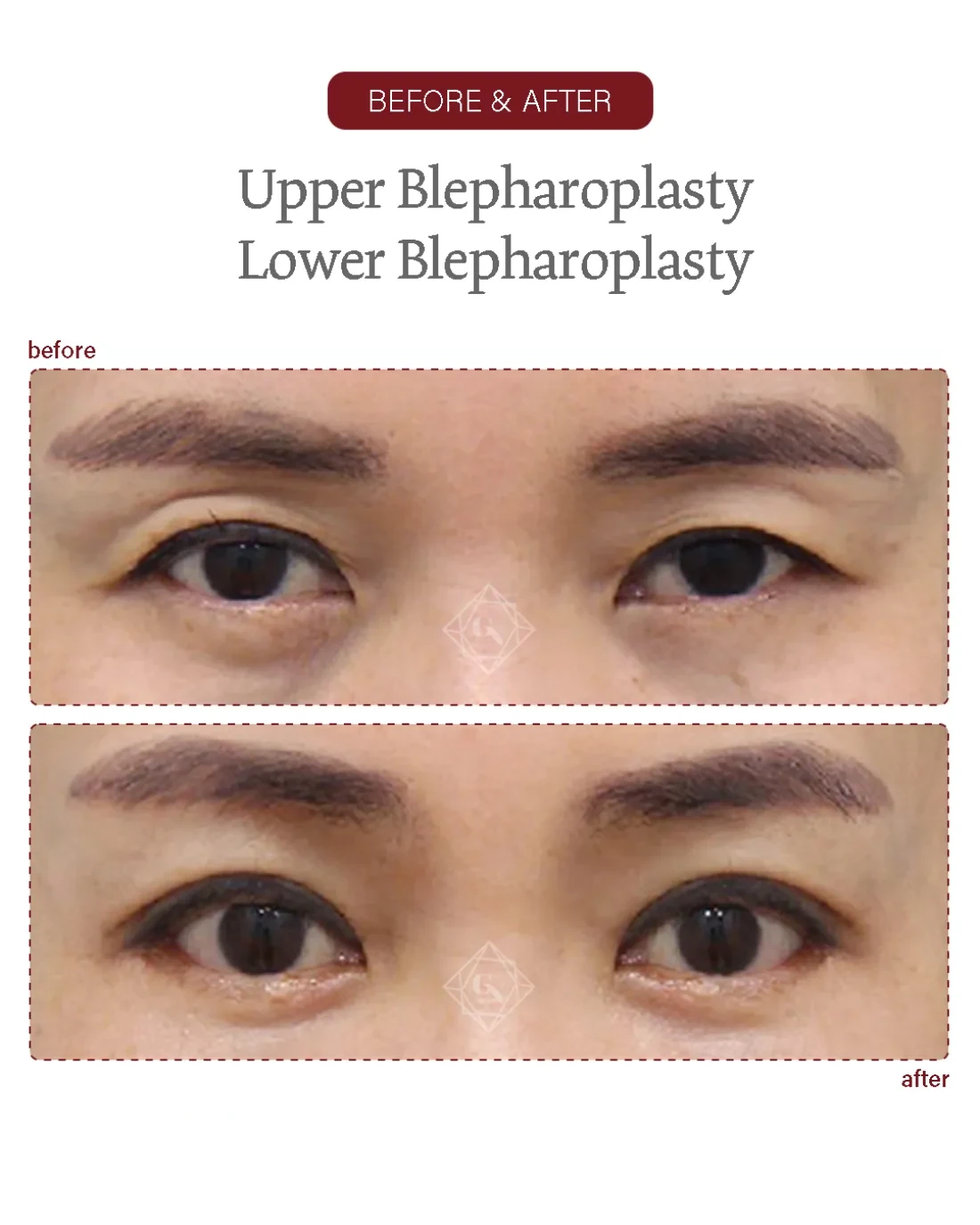 Before and after Upper & Lower Blepharoplasty at Garnet Plastic Surgery, Apgujeong Seoul — actual patient