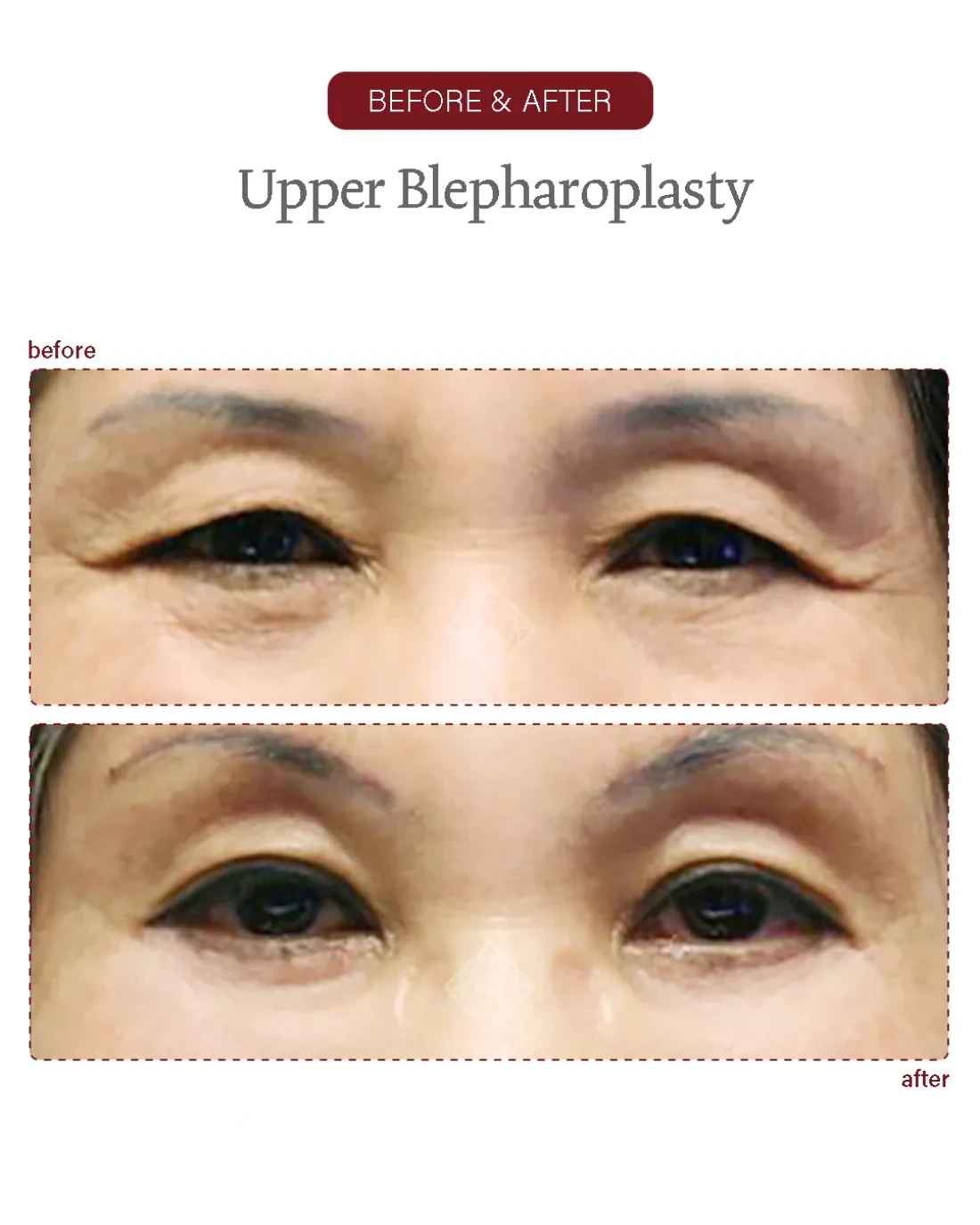Before and after Upper & Lower Blepharoplasty at Garnet Plastic Surgery, Apgujeong Seoul — actual patient