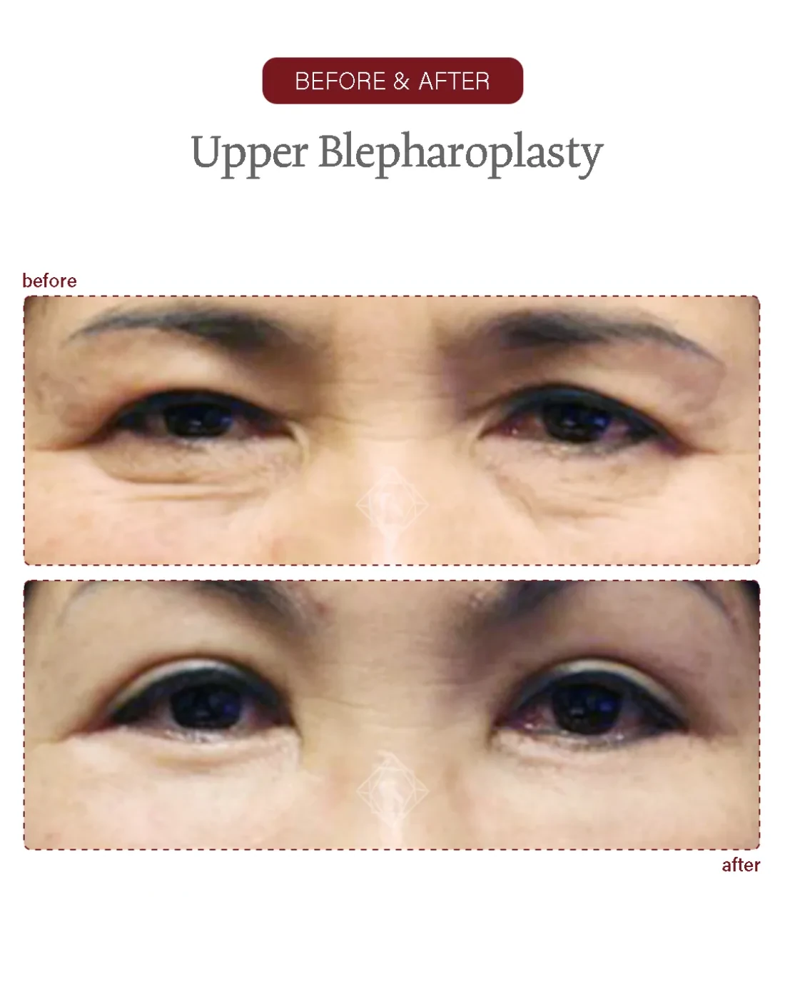 Before and after Upper & Lower Blepharoplasty at Garnet Plastic Surgery, Apgujeong Seoul — actual patient