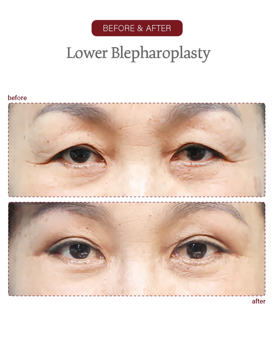 Before and after Upper & Lower Blepharoplasty at Garnet Plastic Surgery, Apgujeong Seoul — actual patient